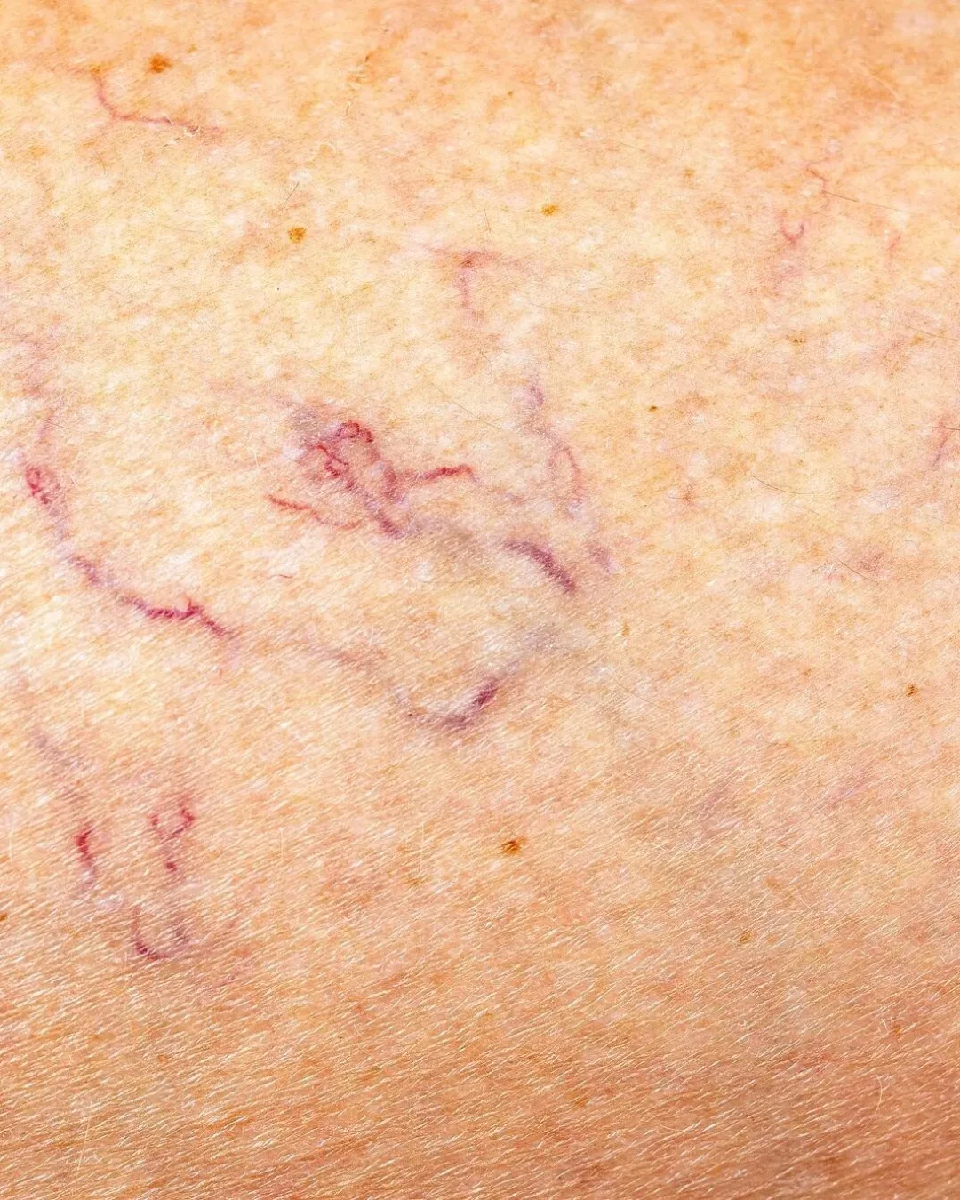 imgi_172_vascular-network-capillaries-female-leg-close-up_233809-843